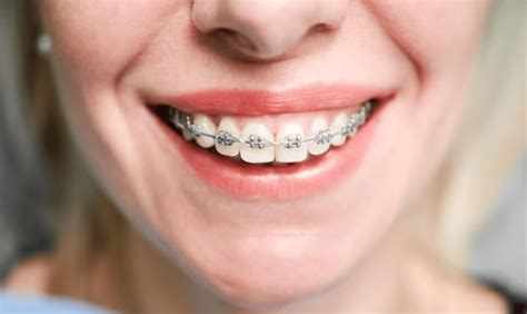 bracket estetico y metalico|champagne vs metal braces.